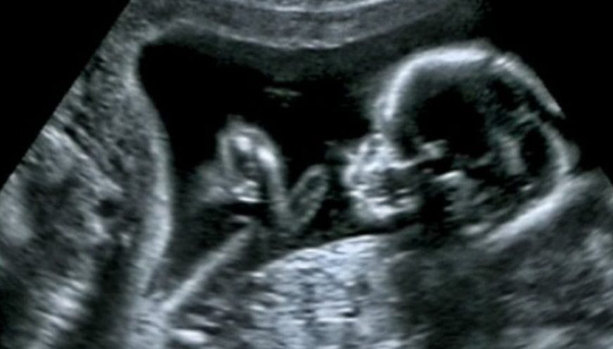 Doktori sheh një rreth të bardhë rreth kokës së foshnjës në eko dhe çuditet, por nëna e kupton të vërtetën kur lind